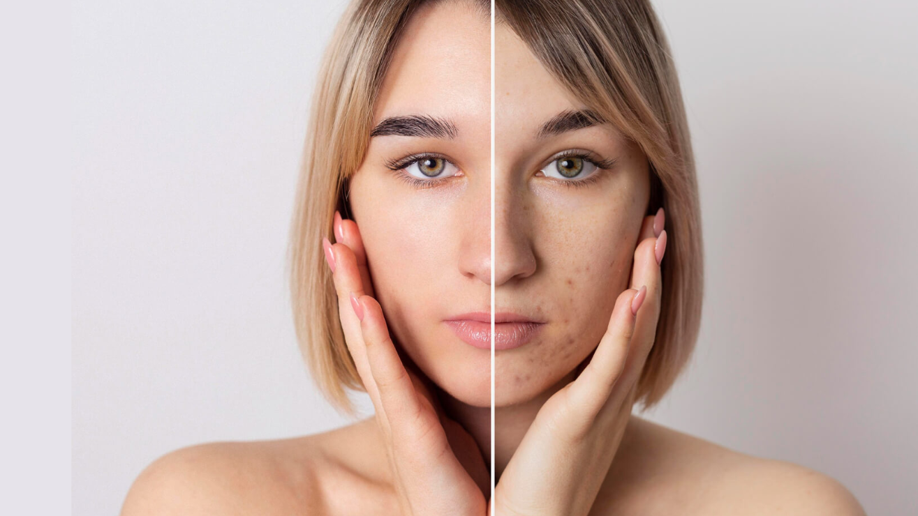 Before and after comparison of a woman's face, showcasing skin improvement related to acne therapy, highlighting clear skin on the left and acne-prone skin on the right, emphasizing the effectiveness of treatments offered by Skin & Body Medical Spa.